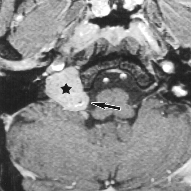 Note soft tissue in hypotympanum. sopharyngeal carotid space without invading the surrounding soft tissues of the deep spaces of the suprahyoid neck.