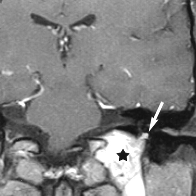 On T, all meningioma cases (5/5) had a permeative, irregular appearance to the bone margins of the jugular foramen and surrounding skull base, with relative preservation of bone density and bone
