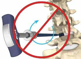 The paddle distractor, reamer distractor, or trial should fit snugly within the disc space with distraction released, but care must be taken to not oversize the implant.