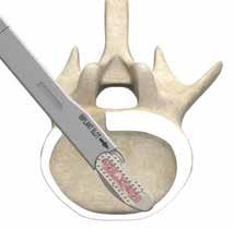 Place the AVS Navigator Implant in the Assembly Graft Block and pack it with autogenous bone graft using the Impactor (Fig. 29 and 30).