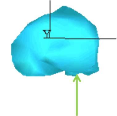 (right) The point of force application was positioned to match the coupled internal rotation seen in the literature that accompanies anterior translation.
