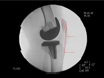Figure 2.10: Patellar ligament and patellar tilt angle determination. the tibiofemoral contacts. The model assumed a unicompartmental contact.
