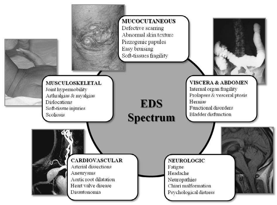Figure 1 A summary of the clinical spectrum of the various Ehlers-Danlos syndromes (EDS).