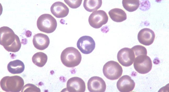 Erythrogram - Validate Data Measure of RBC mass - severity of anemia