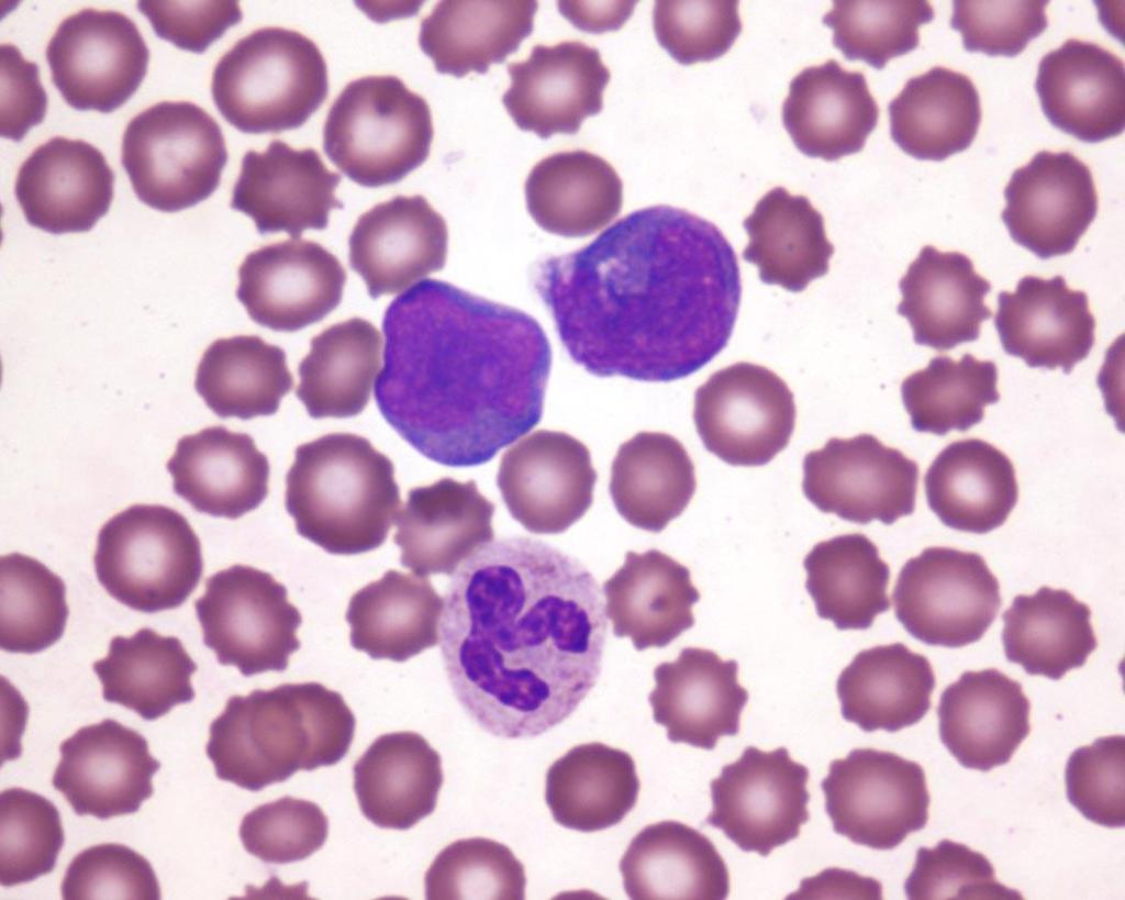 Belle 4-24-13 Poikilocytosis Acanthocytes 2+ toxic hyposegmented