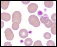 Potential semiquantitation 20,000 x number of platelets seen