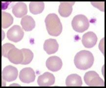 Indicates marrow response to peripheral demand for platelets Thrombocytopenia not