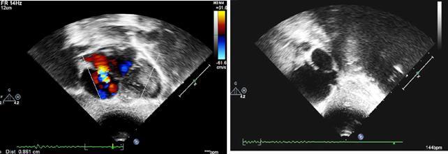 3-Trans thoracic Echocardiography All patients underwent full echocardiographic study using general electric Vivid 5 echocardiography machine using 3.