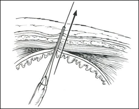 Pass the free end of the suture back through the tom cat catheter, big end first. Figure 20 15.