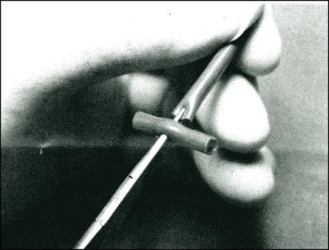 1. Use a scalpel blade or scissors to make a stab incision midlength in the tube anchor (see figure 26