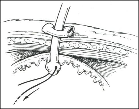 Use a Chinese finger cot suture pattern to secure the tube in to skin (alternate crossing behind, and surgeon s knot in front, until the cot reaches the desired length). 5.