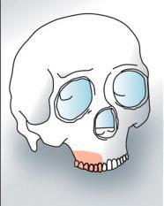 Subclasses f and z: Subclass f includes defects that involve the inferior orbital rim whereas Subclass z have defects that involved the body of the zygomatic bone.