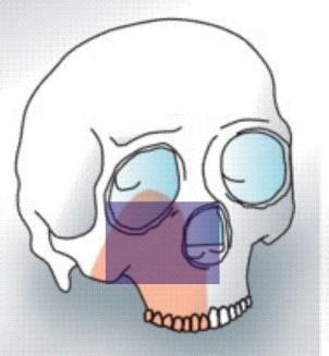 REFERENCES: Figure 13 (Graphic design at RMI) The term composite Maxillectomy can be used where facial skin, soft palate and/or any other part of oral cavity are resected in addition to Maxilla.