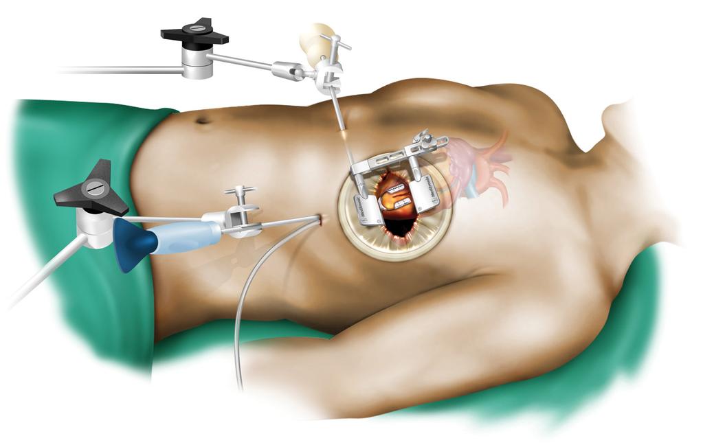 1 What is a MICS CABG Procedure? MICS CABG is a beating heart, multi-vessel CABG procedure in which the anastomoses are performed under direct vision through an anterolateral mini-thoracotomy.