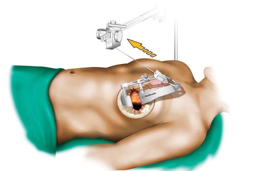 4 6. Access Portals Two access incisions are recommended in multi-vessel MICS CABG procedures - An access incision at the 6th ICS - An access incision below the xyphoid process The incisions should