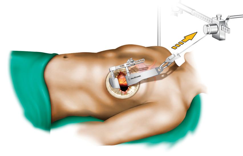 A Perclose A-T (auto-tie) Suture-Mediated Closure (SMC) device may be used to close femoral artery cannulation site. Figure 3.