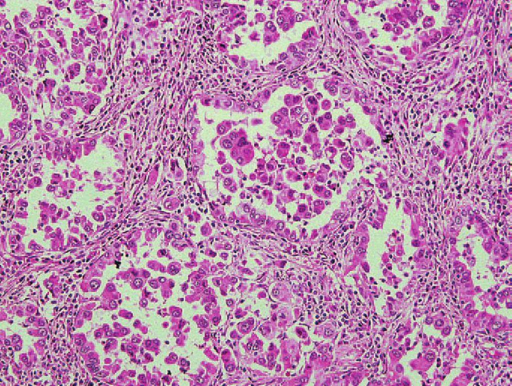 Acinar predominant, this tumor is composed of round-to-oval shaped glands consisting of atypical epithelial cells showing nuclear hyperchromasia and prominent nucleoli (Hematoxylin and Eosin, 200).
