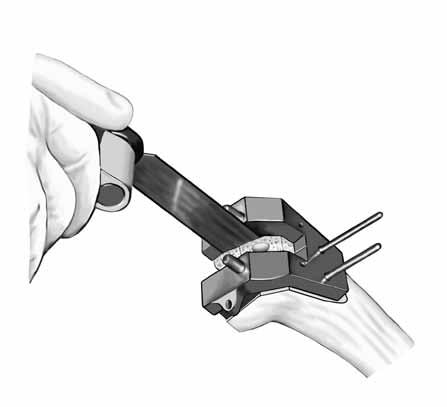 The Notch Guide assembly should be placed on the Reamer. The CC Femoral Notch Guide is pinned through the anterior holes with headless holding pins (Figure 14).