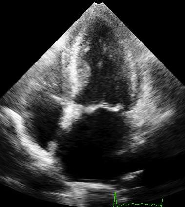 A) 2D apical 4-chamber view at end-diastole and end-systole in an 80-year-old woman with asymptomatic severe aortic stenosis.