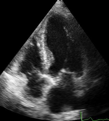 B) Corresponding apical 4-chamber view at 6 months ago showing her V, V, and EF were 75 ml, 34 ml, and 55%, respectively.