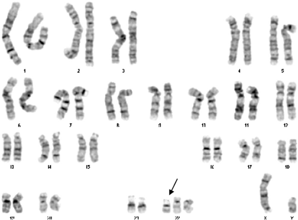 FIGURE 1 Karyotype of the child with Emanuel syndrome [47,XY, þ der(22) t(11; 22)(q23;q11.2)]. according to the manufacturer s instructions.