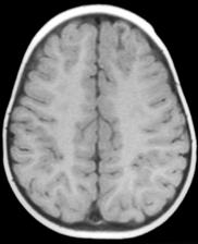 Frontal-parietal-temporal lobes with disconnection of posterior parietal-occipital lobes JC: