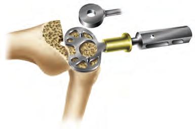 Option B stemmed tibial trials 1 Place a tibial drill guide one size below the femoral component size on the cut tibia to assess coverage. As needed, additional sizes should be templated (Figure 14).