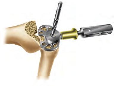 3 With the 11mm tibial collet in place, drill with the 11mm tibial drill (Figure 15) and punch with the 11mm tibial punch (Figure 16). Figure 14 4 Remove the tibial drill guide.