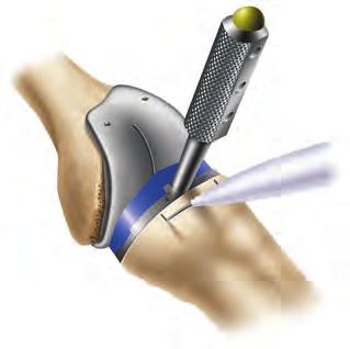 3 Mark correct tibial rotational alignment on the anterior tibia using a cautery knife (Figure 19).