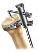 IM tibial highlights Place the intramedullary alignment assembly on the tibia.