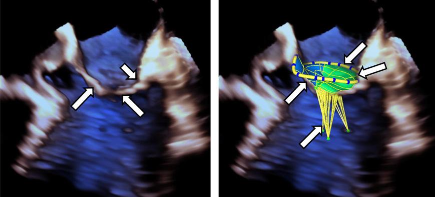T. Mansi et al. / Medical Image Analysis 16 (2012) 1330 1346 1331 Fig. 1. 3D+t transesophageal (TEE) ultrasound image of the mitral valve. the therapy in specific patients.
