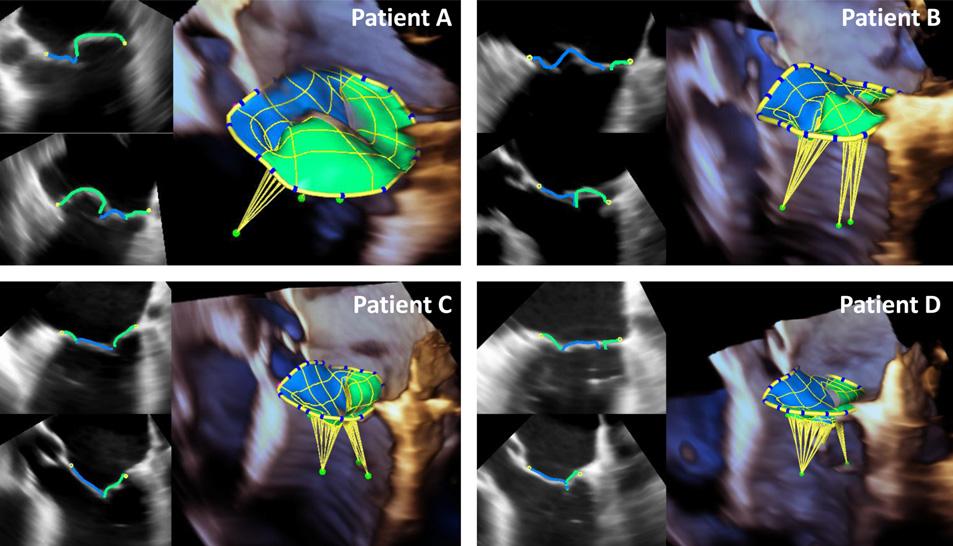 T. Mansi et al. / Medical Image Analysis 16 (2012) 1330 1346 1337 Fig. 9. Automatic detection of the MV apparatus on 3D+t TEE sequences of four patients with different diseases.