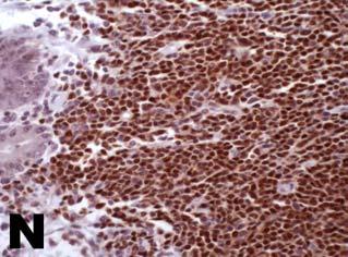 E) CD3 staining in a reactive tonsil (x20). F) CD4 staining in a reactive tonsil (x20).