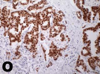 N) Cyclin D1 staining of a mantle cell lymphoma in stomach (x40).