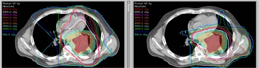 3D vs Proton for NSCLC Proton Photon 3D CRT NRG Oncology Summary Amazing