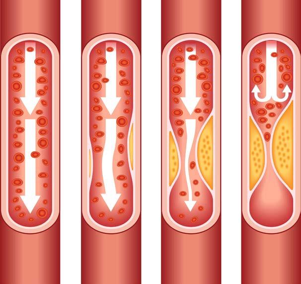 Complications overview (2) Atherosclerosis A disease where an artery wall thickens as a result of accumulation of fibrofatty plaques.