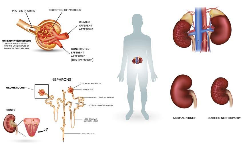 Complications: chronic kidney disease Patient education Renal failure is one of the complications resulting from hypertension.