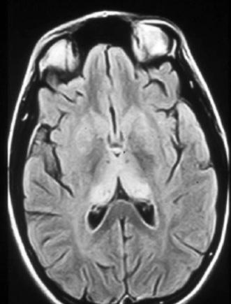 Diagnosing CJD As at January 2008, there is no absolute test for CJD. A definitive diagnosis is currently only possible by post-mortem examination of the brain for spongiform change.