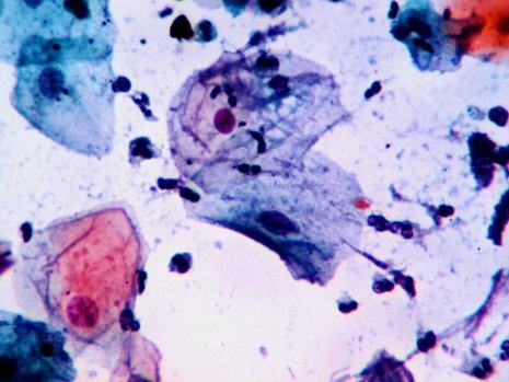 PAP stained smear shows mature basal and intermediate cell with inflammatory cells in the background Fig2b.