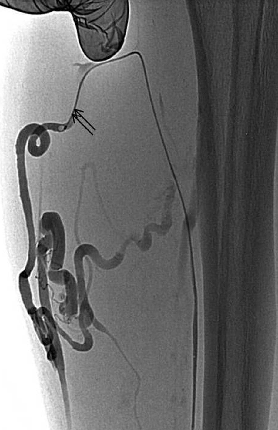 6-Fr microcatheter was placed into the guiding catheter coaxially, selective catheterization of the varicose tributaries followed by a venogram through the microcatheter was performed, to ascertain