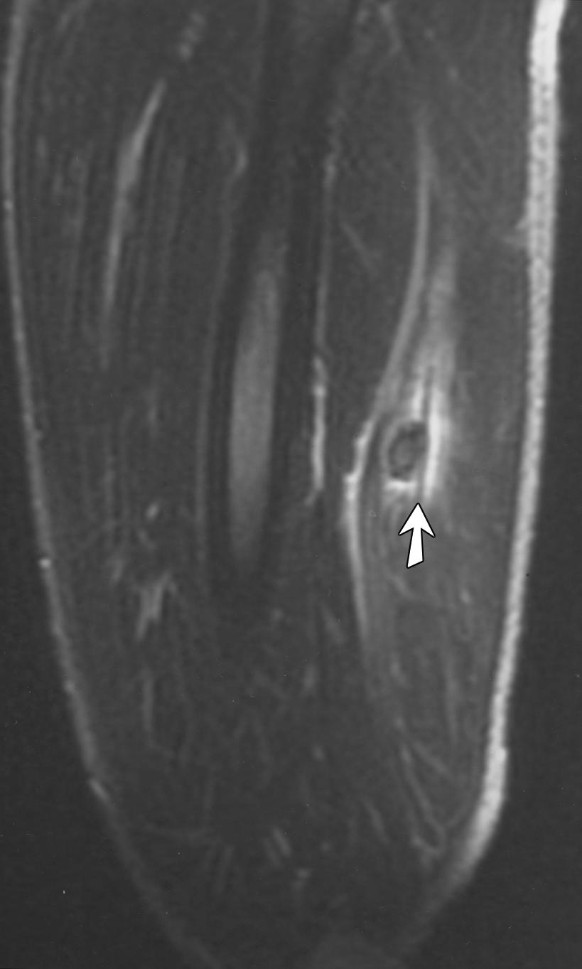Sagittal fast spin-echo T2-weighted MR image with fat saturation shows high signal intensity surrounding linear low-signal-intensity tendon (curved arrow) with dissection along muscle fibers in