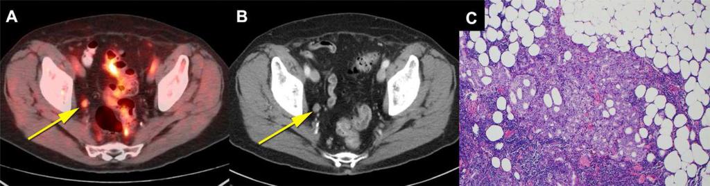 Odewole et al. Page 17 Fig. 5. True positive lymph node on both fluciclovine PET-CT and CT 76 year old patient had external beam radiation therapy for prostate cancer with subsequent rise in PSA to 5.