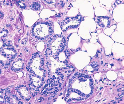 D, Synchronous metastasis to the pubic ramus with crush artifact but morphologic features consistent with the primary breast tumor (H&E, 200).