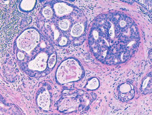 Esposito et al / Encapsulated Papillary Breast Carcinomas A B C D E F zimage 4z
