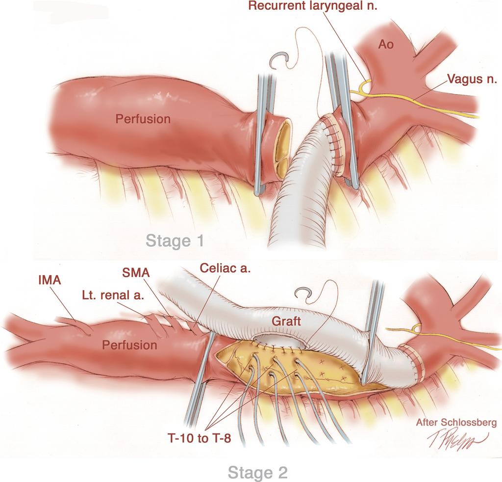JOURNAL OF VASCULAR SURGERY Volume 50, Number 4 Black 939 Fig 3. Sequential stages of Type II TAAA.