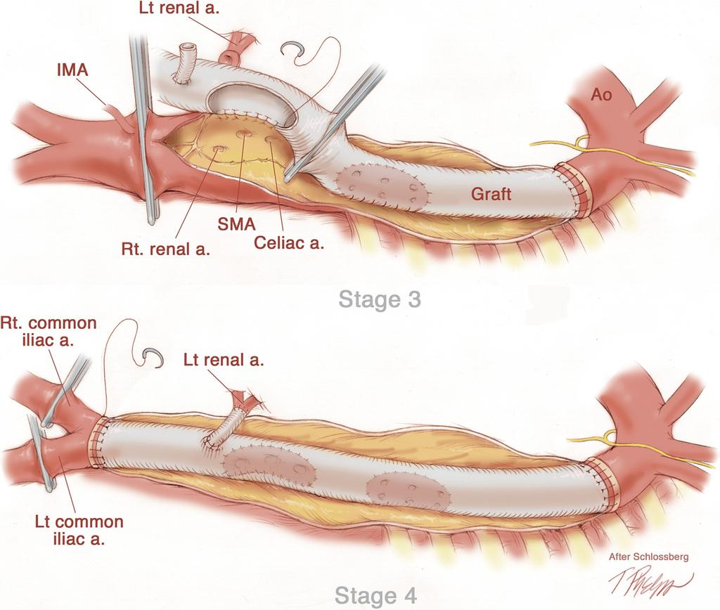 940 Black JOURNAL OF VASCULAR SURGERY October 2009 Fig 4. Sequential stages of Type II TAAA.