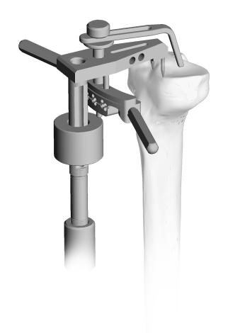 Zimmer MOST Options System Surgical Technique 9 Zero Degree Tibial Slope A zero degree tibial cut is recommended to accommodate the cone of the hinged tibial baseplate into the tibia.