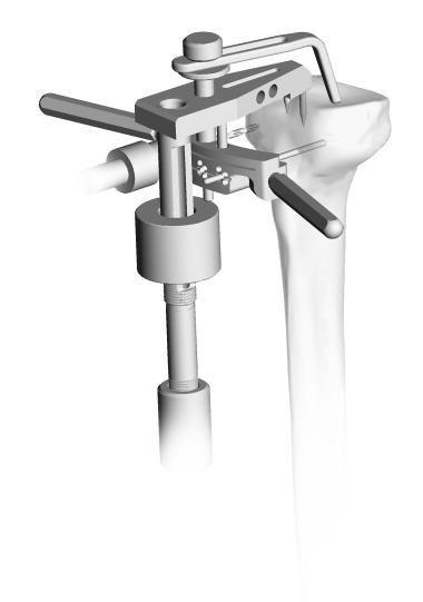 The total thickness of the hinged tibia, hinged tibial insert, 4mm MOST Options hinge is 15mm. The stylus will position the tibial saw guide 10mm below the point of reference.