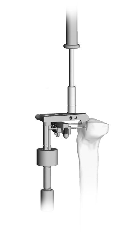 If it appears that an inadequate resection will occur, adjust the tibial saw guide in 2mm increments to a lower level. Use angled retractors to protect soft tissue and ligaments.