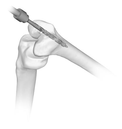 Zimmer MOST Options System Surgical Technique 25 Femoral Preparation Femoral Medullary Canal Preparation The femoral instrumentation of the MOST Options System is keyed off the intramedullary stem